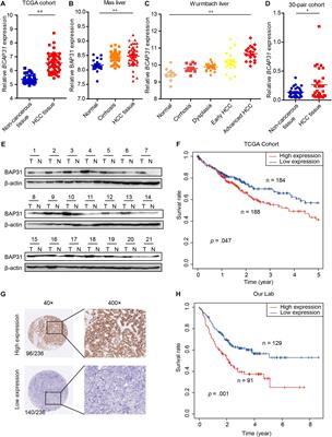 B-Cell Receptor-Associated Protein 31 Promotes Metastasis via AKT/β-Catenin/Snail Pathway in Hepatocellular Carcinoma